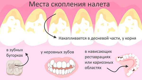 Налет на детских зубах. Лечение кариеса у детей Красноярск